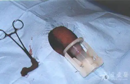 几例环扎压榨型包皮环切术