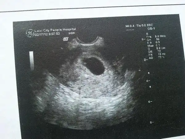 产科医生告诉你:怀孕多久查第一次b超最靠谱?