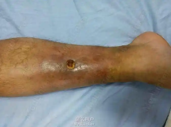 皮肤溃疡,可能不只是皮肤病-医联
