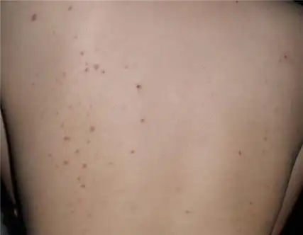 艾滋病初期小红点照片易混淆的艾滋病症状都有哪些