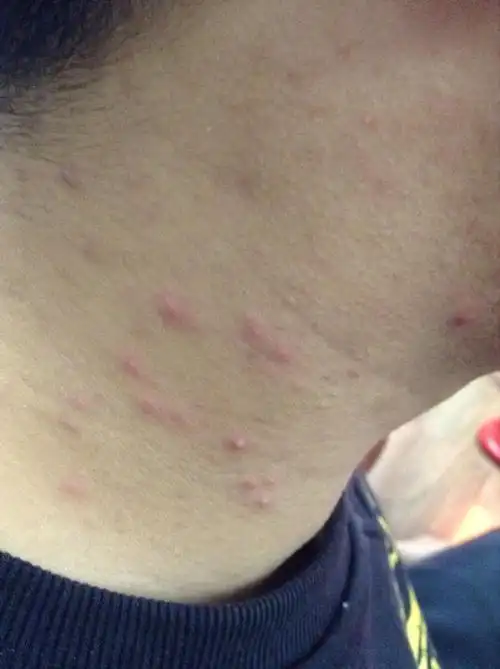 身上2个地方长痘或和艾滋病有关生活中年轻人尽量多注意