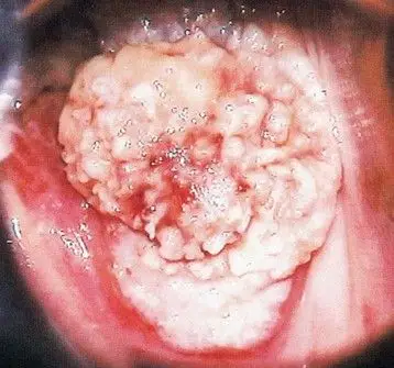 分期讨论宫颈癌的治疗
