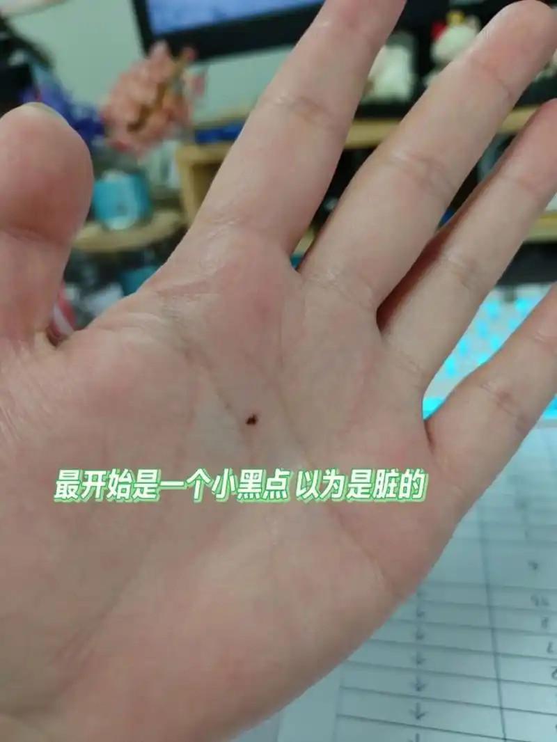 左手手心突然长了一颗痣是怎么回事?