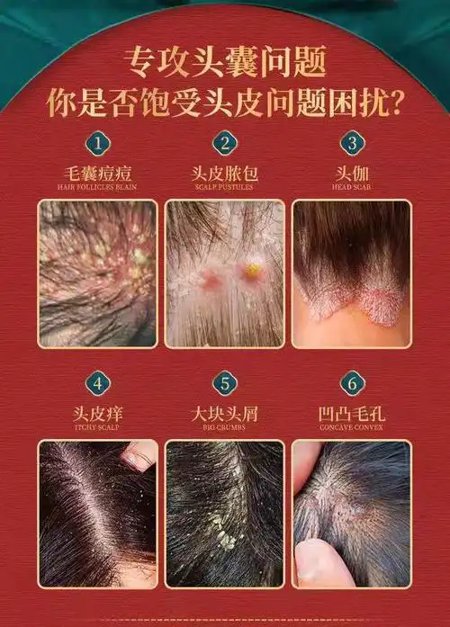 药房直售头皮去屑洗发水头皮屑脂溢性皮炎头皮癣脓包疙瘩膏jy洗发水3