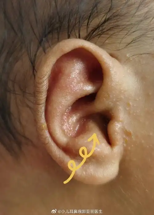 这个宝宝1月龄,轻微耳廓形状畸形,畸形部位是耳甲腔,软骨局部隆起(图1