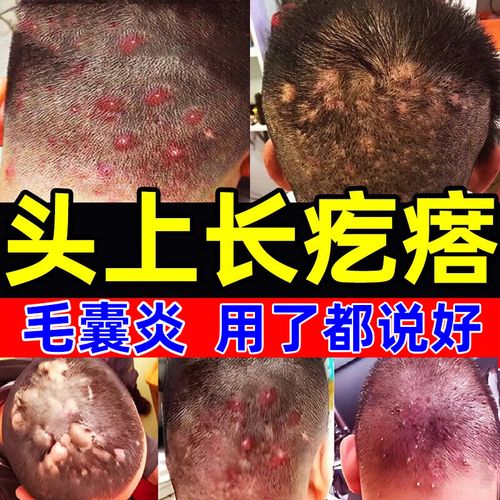 祛痘 脓疱疮 毛囊炎头上前胸后背长疙瘩痘痘脓包发痒流脓用复方醋酸