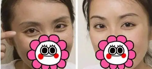 自体脂肪填充眼睛凹陷危险吗?