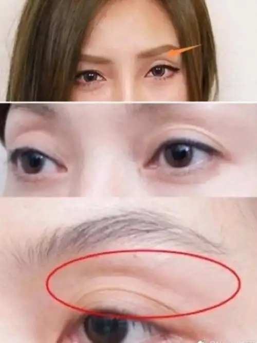 比人中长更显老的是眼窝凹陷