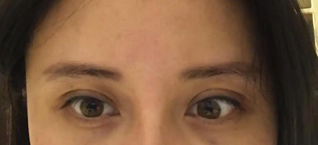 双眼形态不对称眼提肌无力大小眼怎么办