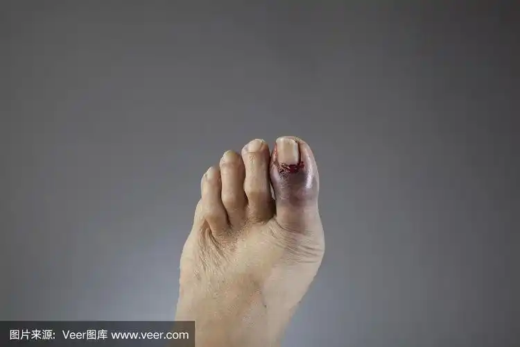 左脚脚趾骨折