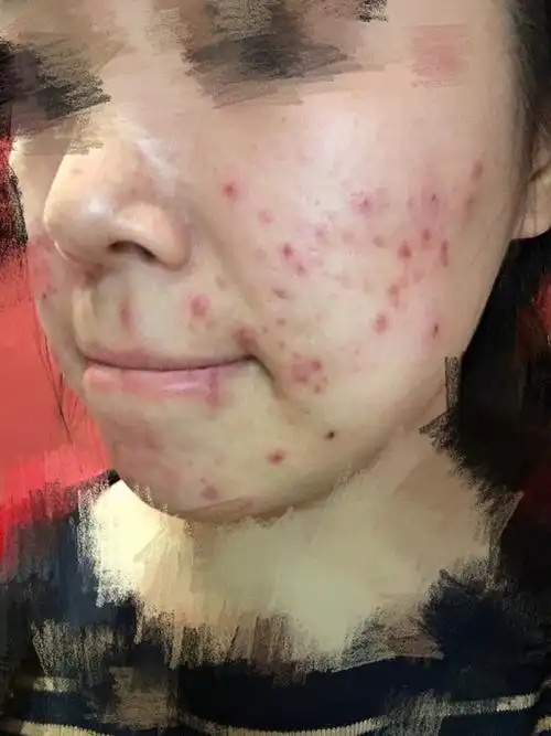 果酸换肤日记 第一次