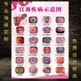 宫颈疾病示意图妇科墙贴病变级别海报女性子宫图片美容院挂图广告