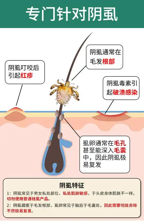 阴虱男私处用10硫磺软膏去虱子乳膏百部酊喷雾林ld旦乳膏孕妇女成人用