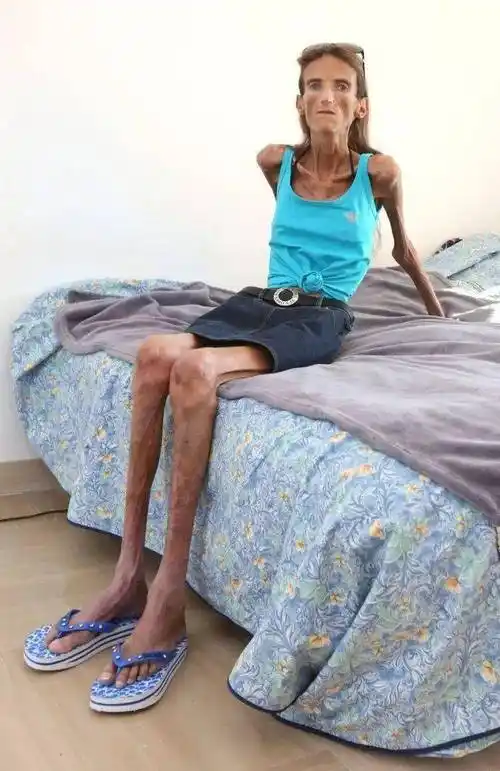 世界上最瘦的女人:从开朗自信到堪称行走的骷髅_减肥_身体_身材