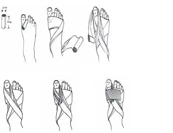温建民教授微创治疗拇趾外翻答疑