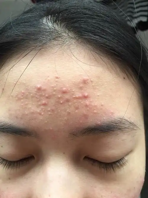 脸部毛囊炎吃药吃多久