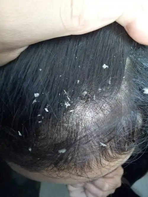 很是烦恼,局部头皮屑发黄,中间一些地方红点,痒!