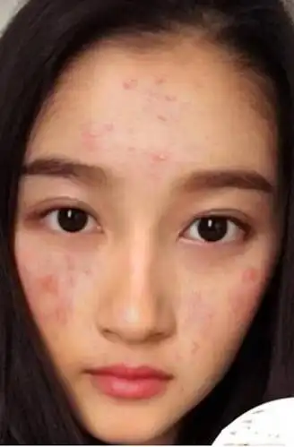 红肿,痤疮p了一脸不止杨幂,被故意p黑图的还有赵丽颖这样拿着杨幂的