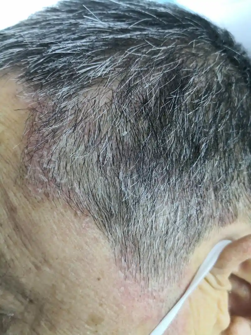 要排查一下银屑病症状.#银屑病##脂溢性皮炎