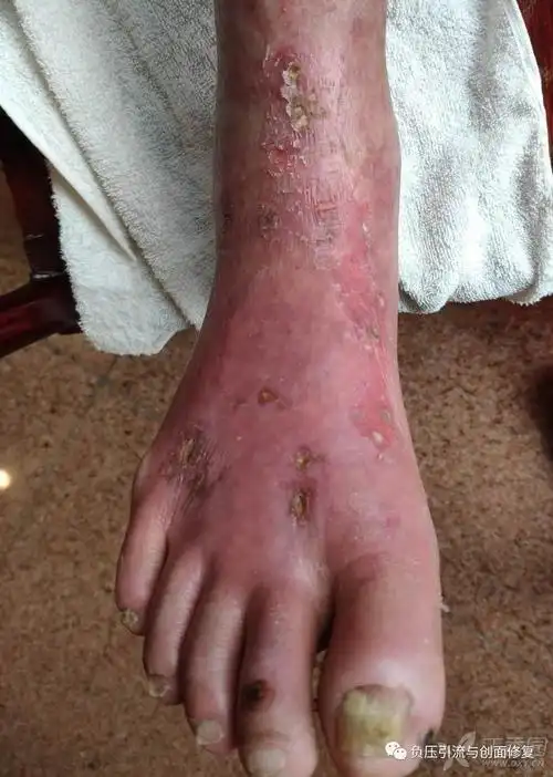 看图说话:这个糖尿病足的照片,提供哪些信息?