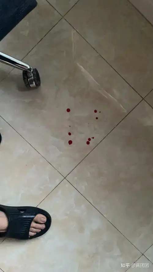 我的痔疮手术经历