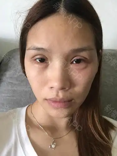 玻尿酸丰卧蚕好不好_效果图_tina_hui168玻尿酸丰卧蚕术后第5天_新氧