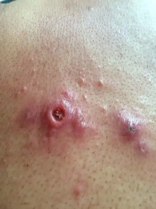 有人知道这是什么病吗开始时痘痘很痒抓破了后中间就结痂了