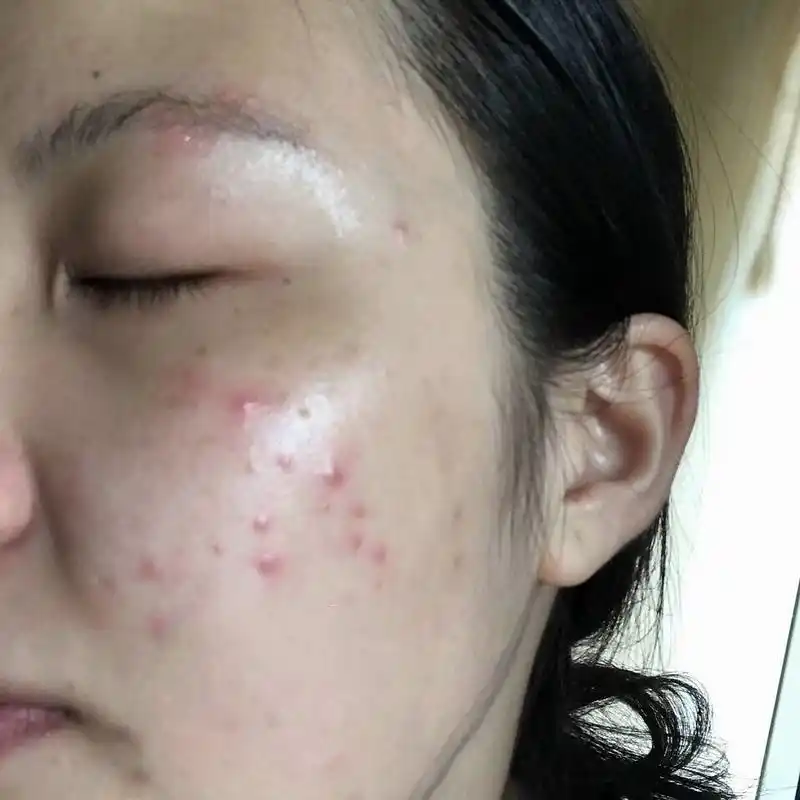 皮肤缺水会导致细胞的体积越来越小,而慢慢产生细纹,如果不及时补水