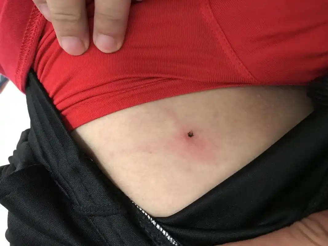 武汉女子胸腹部惊现会动的"黑痣"!遇到这个千万别硬来!已有多人中招