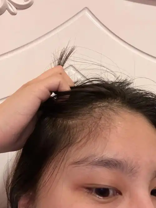 发际线低怎么办