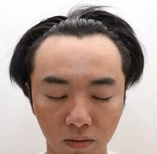 原创网友称华晨宇是自己老公还晒出多张华晨宇植发照片称张碧晨是小三