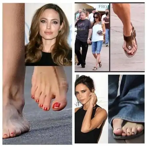 长期穿下来还可能患上拇外翻的,很多女明星,都是拇外翻,比如贝嫂