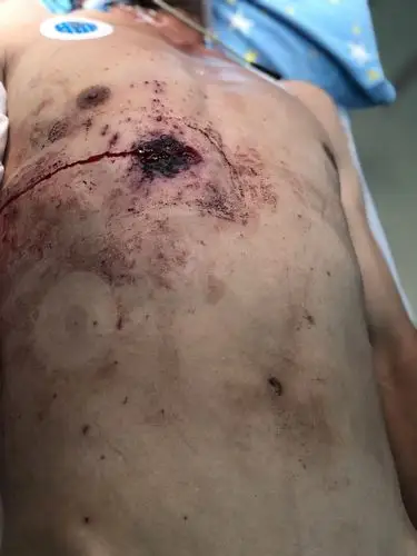 枪击伤:尽量而不强求彻底取除子弹,止住血,通畅引流 - 好大夫在线