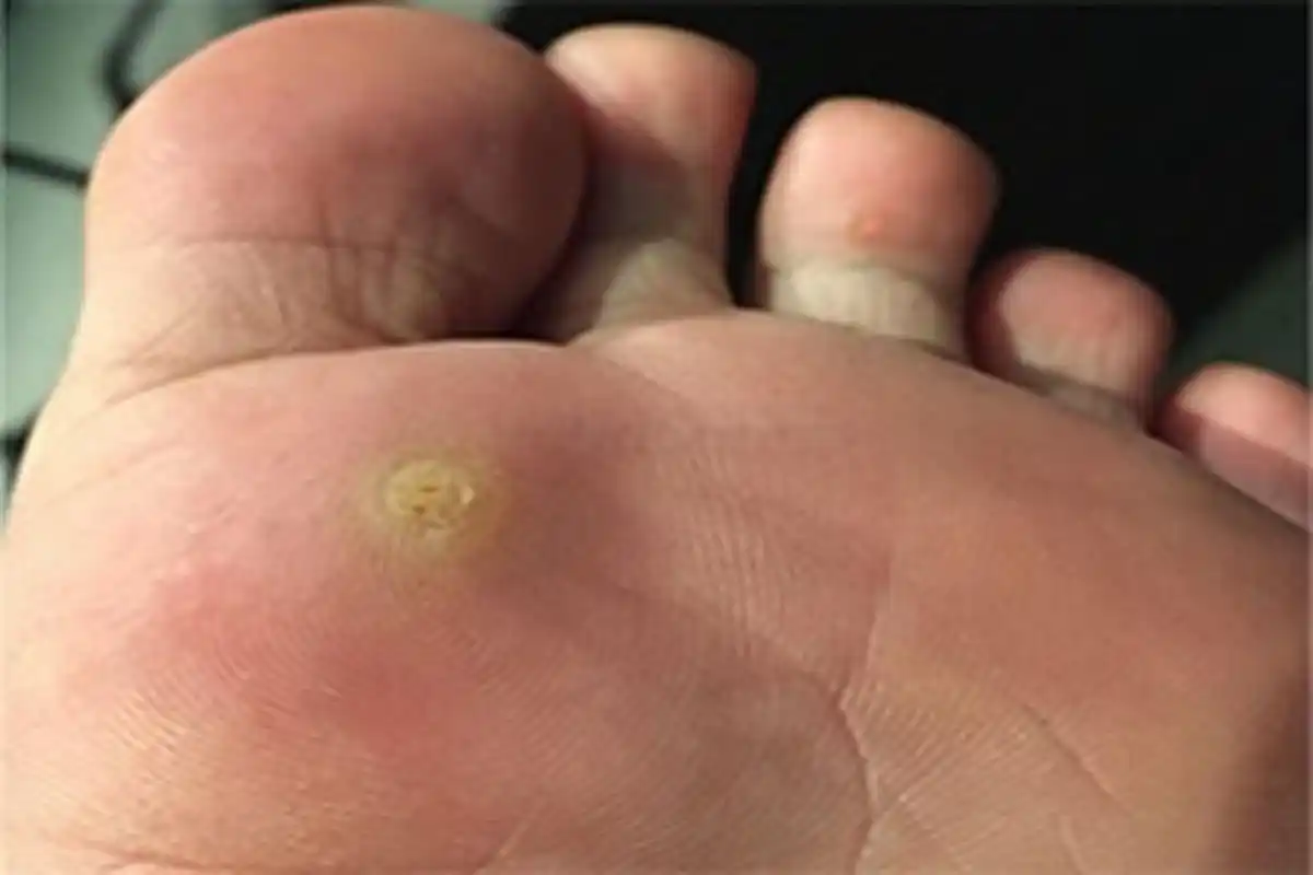 以下这三种疣都是由hpv感染引起的,一定要重视  1,#丝状疣# ,主要是在