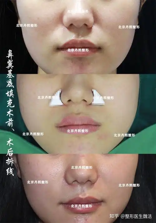 鼻基底凹陷填充对比照片 加强型膨体垫鼻翼基底 - 知乎