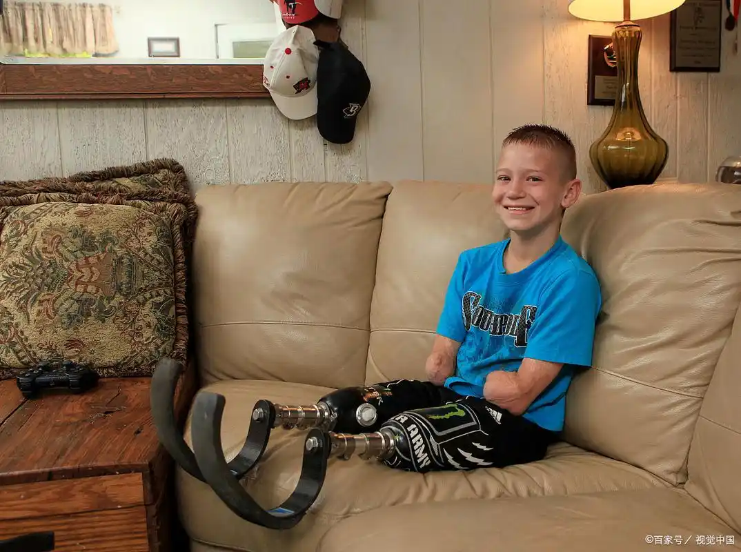 没有四肢的小孩不是重点,假肢以及他开朗乐观的态度才是重点
