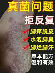 脚后跟干裂真菌脚癣脚藓脚底脚上真菌感染脚气止痒脱皮烂脚丫药膏