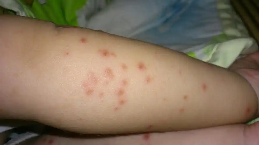 急我家儿子一周一长红疹不知是什么啊