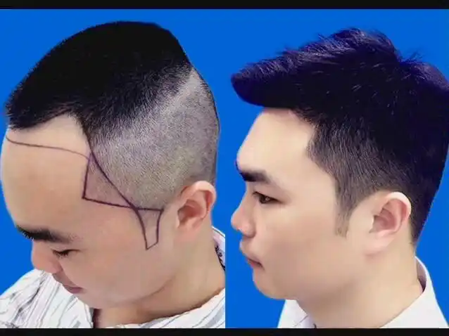 李先生植发鬓角一年效果对比图