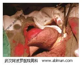 检查系带钛钉缝合情况