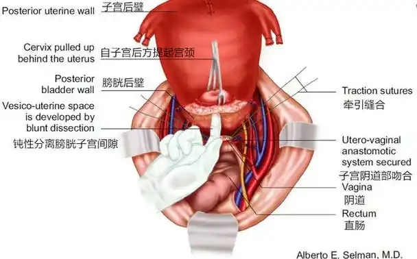 图文并茂:经道格拉斯窝逆行的全子宫切除术