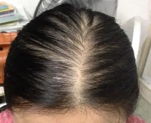 产后脱发,坚持用1方,护发补气血