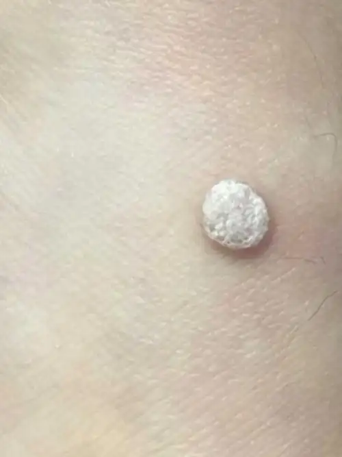 一些疣的病例疣是临床常见皮肤病之一,俗称"瘊子",_圈子-新氧美容整形