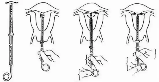 为什么不建议女人上环 (上环后最忌讳的动作)