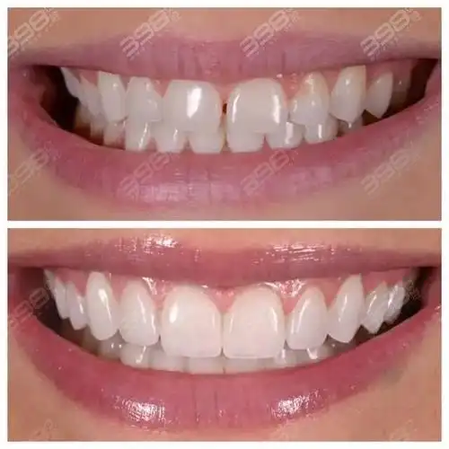 get这四种美牙方法牙齿变白不是梦