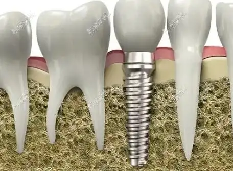 种植牙模型图