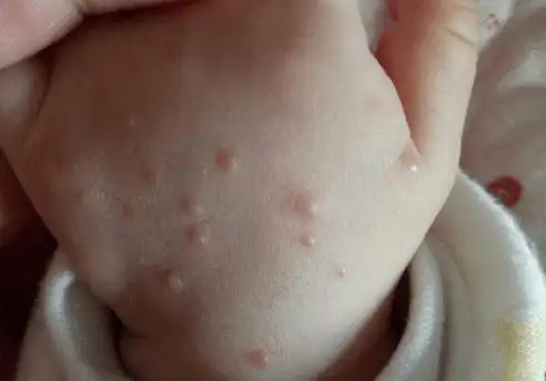 儿童各种皮肤病对照图