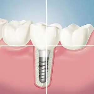 福州科尔口腔医院建议您可以尝试科尔生物活性种植牙,它美观逼真,成活
