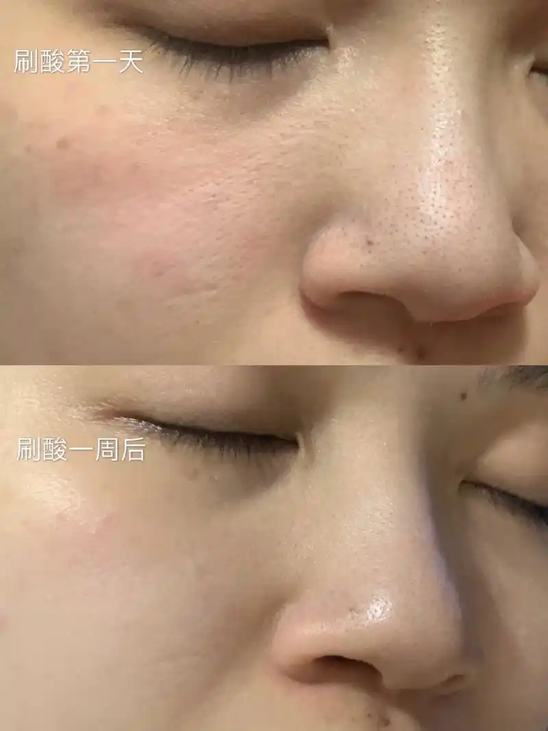 果酸焕肤一周后