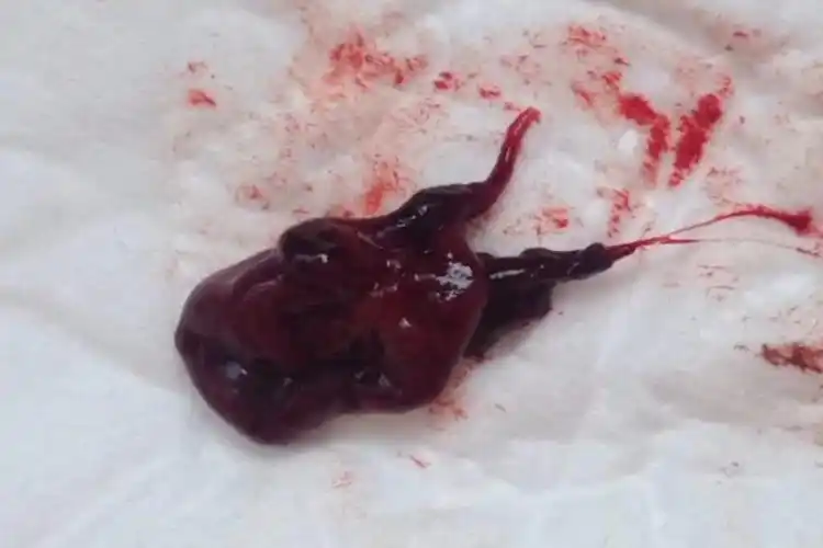 形状类似于小海马,但若在孕5周流产,此时分辨胎儿的形状,大小意义不大